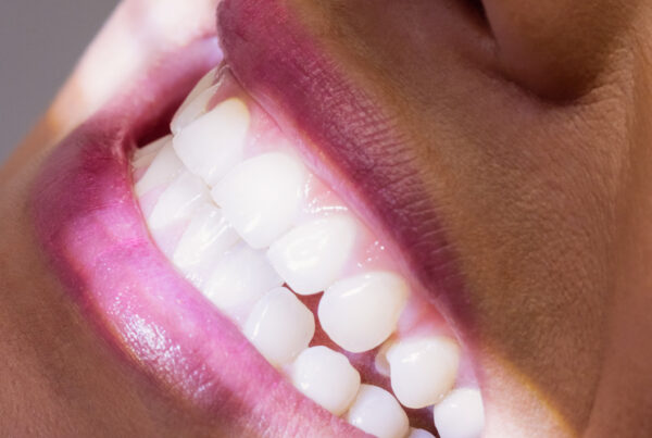 Blanqueamiento dental clinica dental en el centro de Valencia.