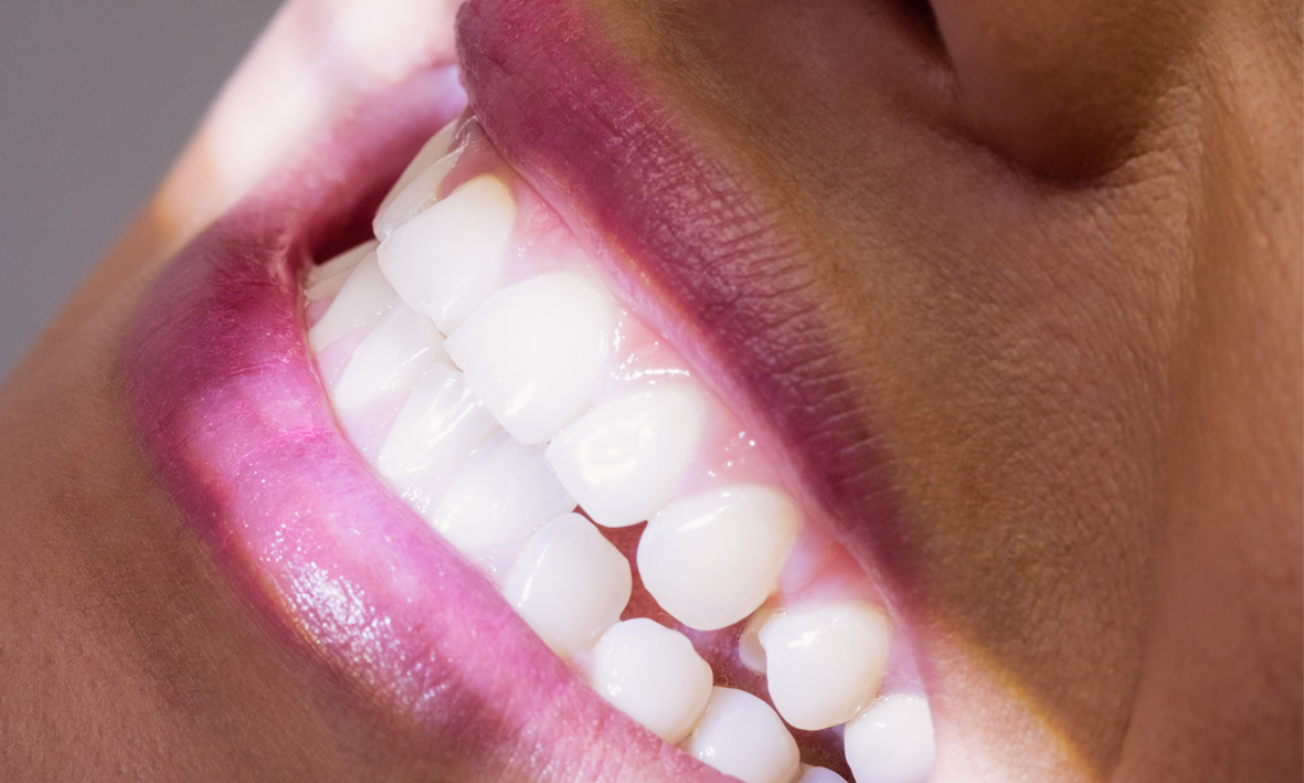Blanqueamiento dental: todo lo que necesitas saber