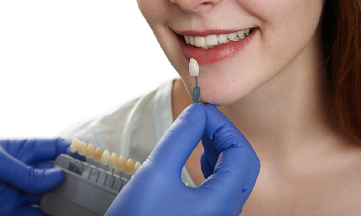Lo que necesitas saber sobre los implantes dentales