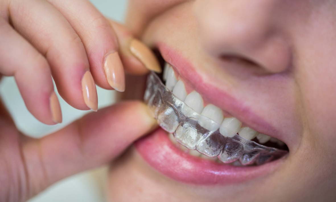 Ortodoncia: cómo alinear tus dientes y mejorar tu sonrisa a cualquier edad