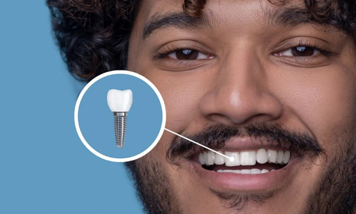 Todo sobre las coronas dentales: cuándo se necesitan y cómo se colocan