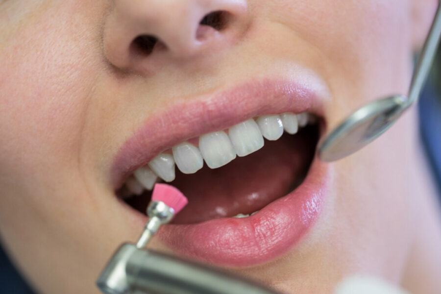 Beneficios de la limpieza dental
